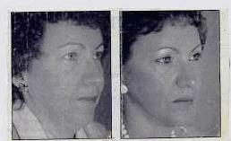 Facelift_2_crop_crop